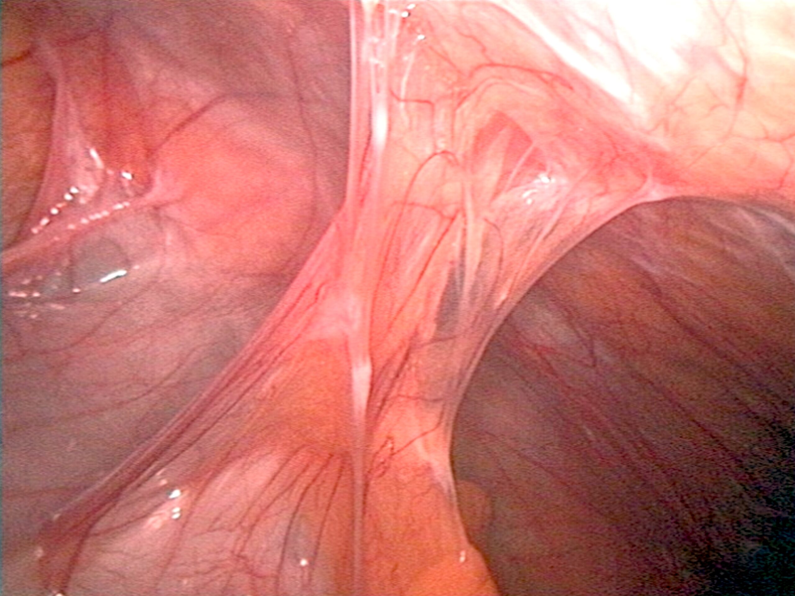 Uterine fibroids