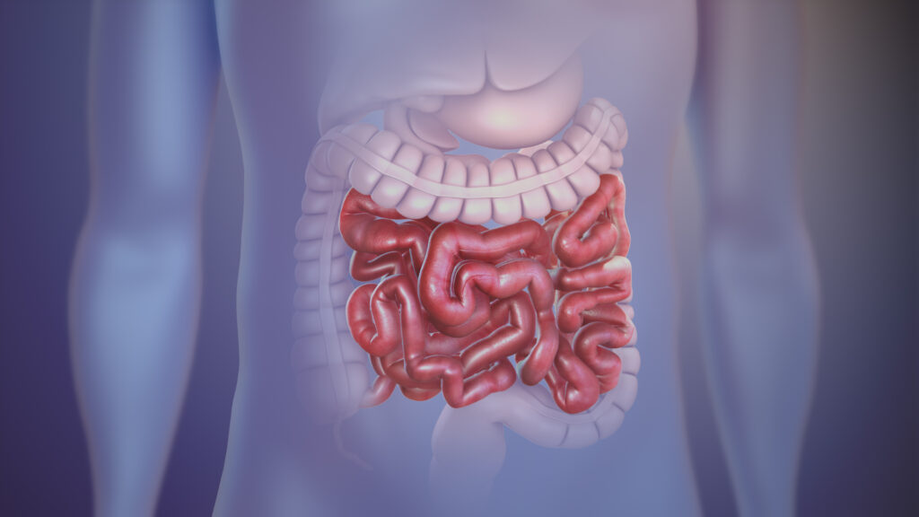 bowel endometriosis